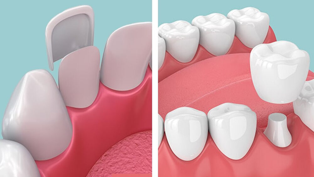 تفاوت ونیر کامپوزیت با روکش دندان-دکتر دندانپزشک گرگان-آذین کمال پور