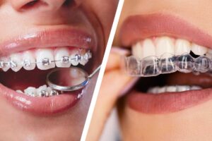 اینویزیلاین یا ارتودنسی شفاف چیست؟