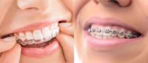 اینویزیلاین یا ارتودنسی شفاف چیست؟