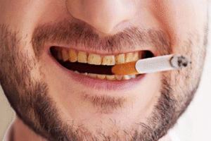دود سیگار باعث تغییر رنگ دندان بلیچینگ یا لمینت شده می شود.